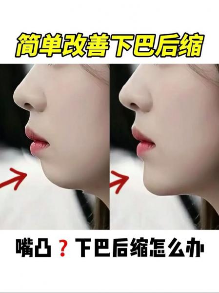 垫下巴后注意事项，垫下巴后多久可以正常说话